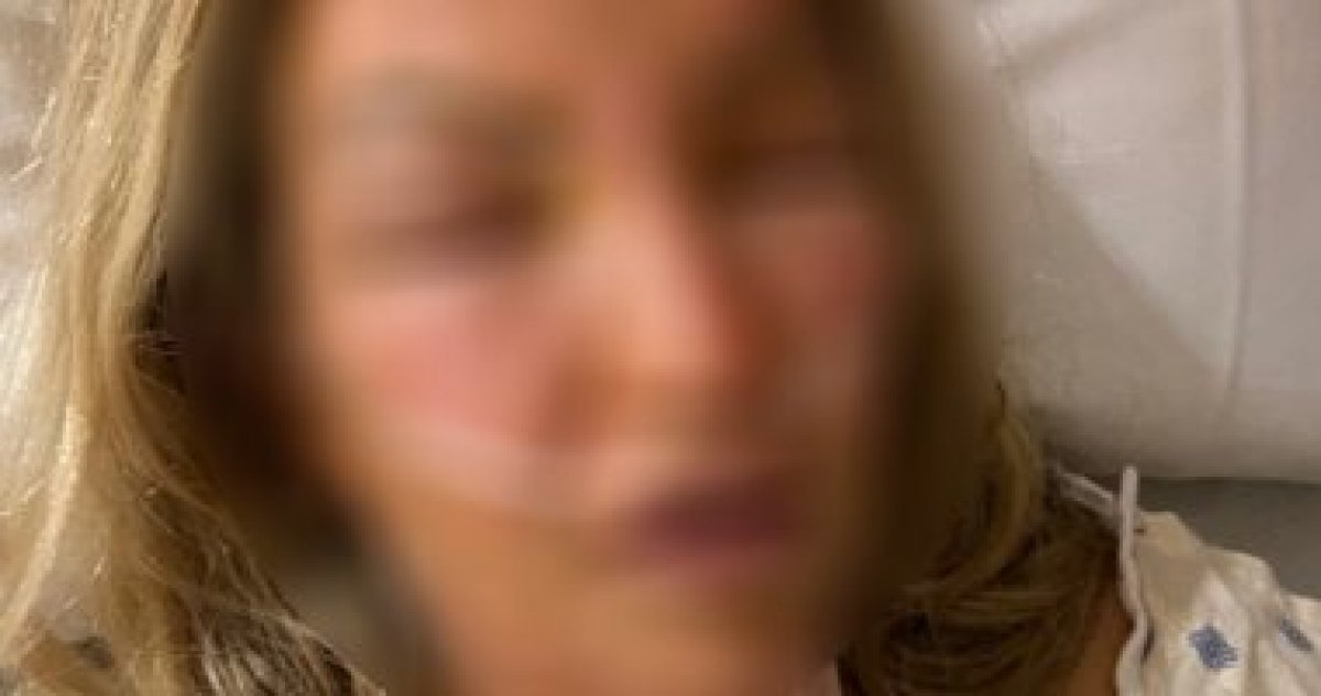 معقم اليدين المحتوى على الكحول تسبب فى حدوث حروق شديدة بجسم امراة أمريكية