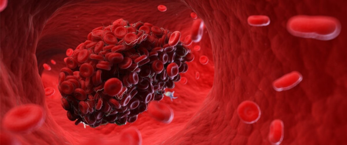 7 علامات تدل على إصابتك بجلطة دموية 