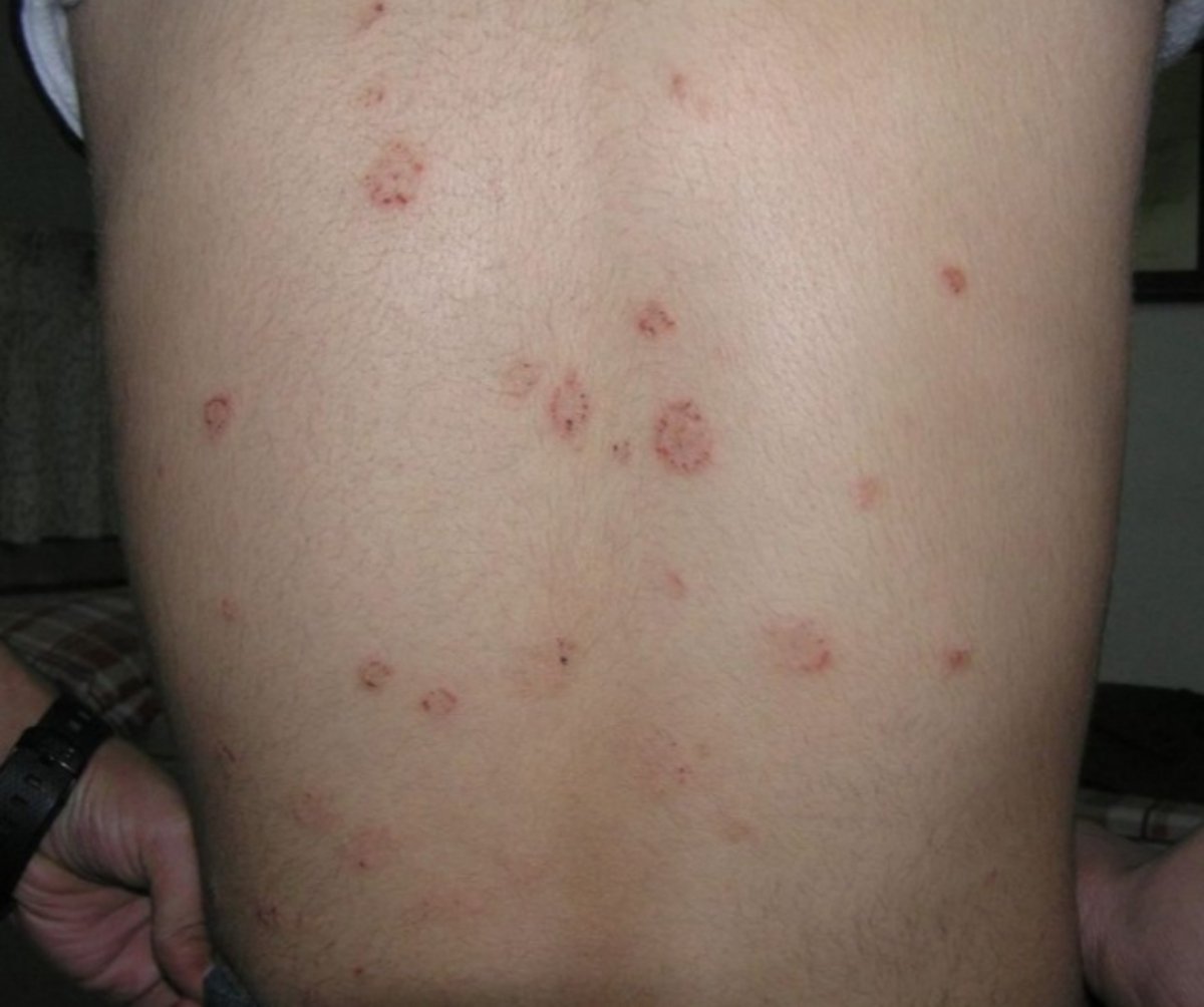 بالتشابه مع أعراض الكورونا، مرض جلدي منتشر بين الأطفال والمراهقين.. فما هو؟