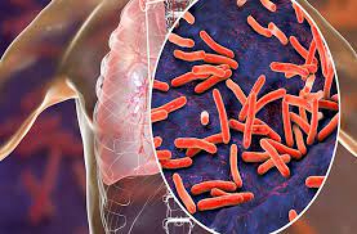 مصر تسعي إلى مكافحة وباء السل و خفض المعدلات الإصابات 