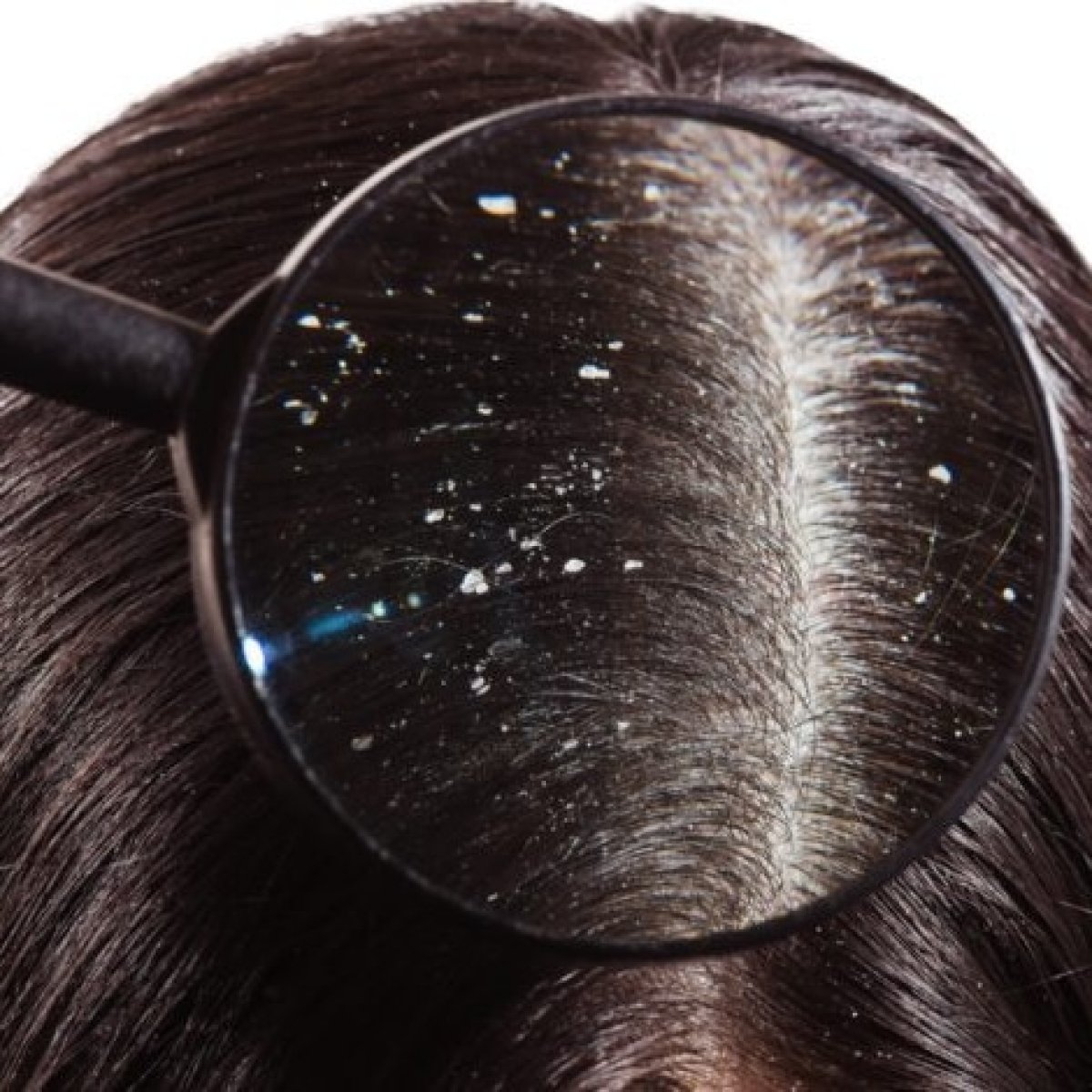 ثلاثة وصفات طبيعية لعلاج القشرة من الشعر.. تعرفي عليهم