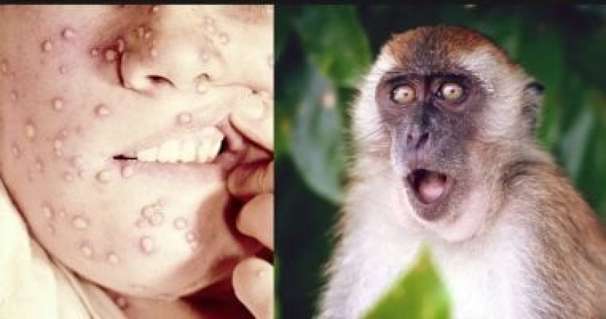 كل ما تريد معرفته عن جدرى القرود.. التقبيل ينقل العدوى والوقاية بلقاح