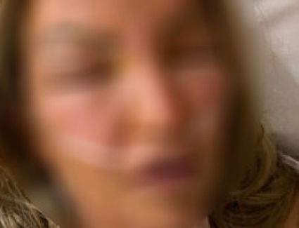 معقم اليدين المحتوى على الكحول تسبب فى حدوث حروق شديدة بجسم امراة أمريكية