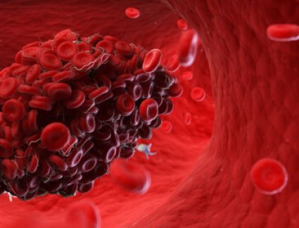 7 علامات تدل على إصابتك بجلطة دموية 